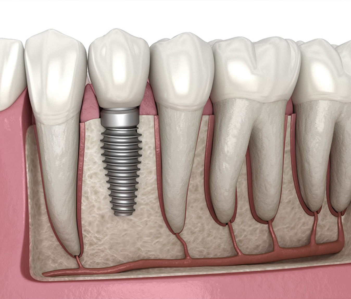 Dental Implants