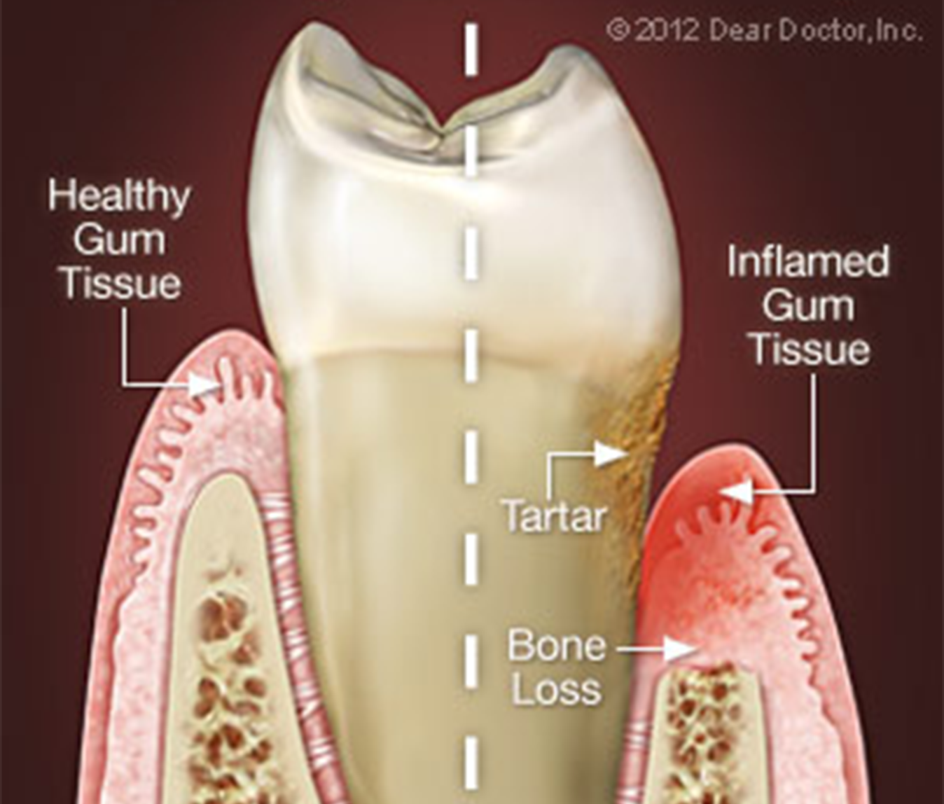 Periodontal Disease